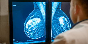 Breast Cancer Causes